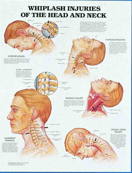 Whiplash Injuries to the Head and Neck Chart - MedWest Medical Supplies